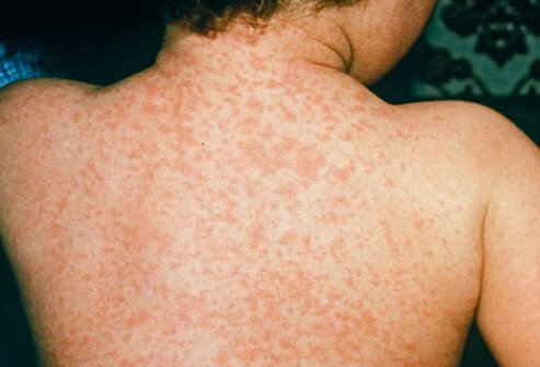 Measles rash.